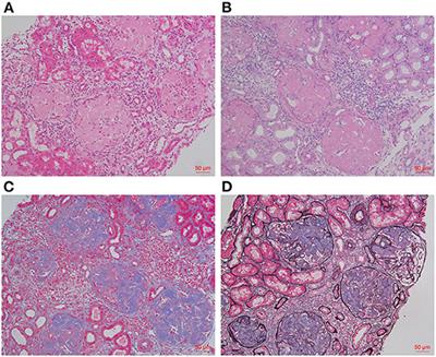 Fibrinogen A Alpha-Chain Amyloidosis in Two Chinese Patients